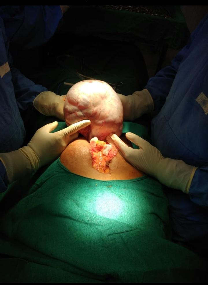 Laparoscopic Ovarian Cystectomy Surgery